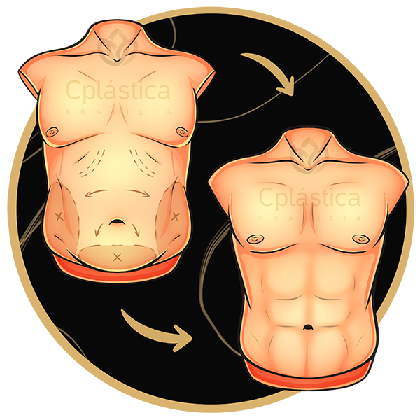 Men's High Definition Liposuction