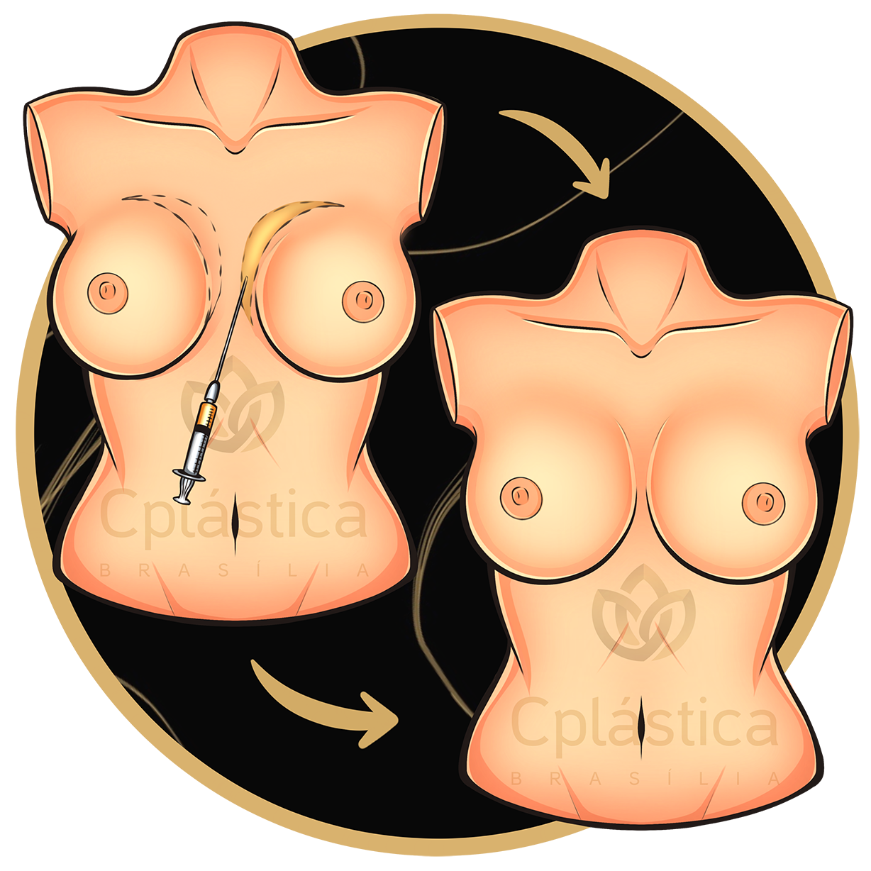 Hybrid or Composite Breast Surgery
